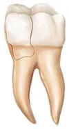 Image of Cracked Tooth
