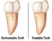Image of Cracked Tooth