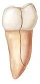 Image of Cracked Tooth