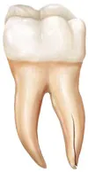Image of Cracked Tooth